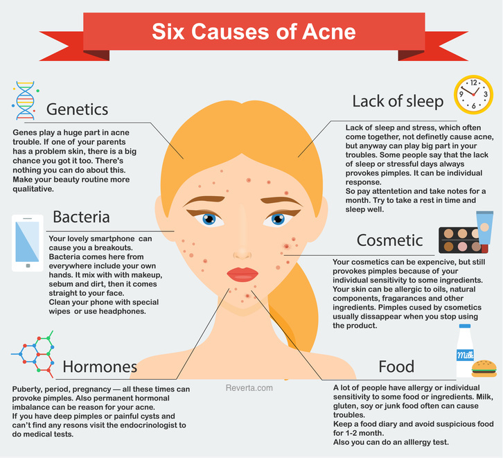 [15] Causes of Acne | Why You Break Out